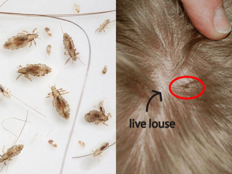 How Lice Spreads | FAQ | Lice Removal Products and Treatment